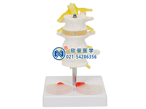 三節(jié)腰椎附兩個(gè)病變椎間盤模型